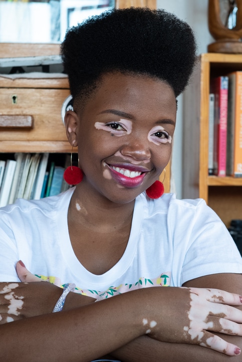 Young Black woman with vitiligo smiling at the camera